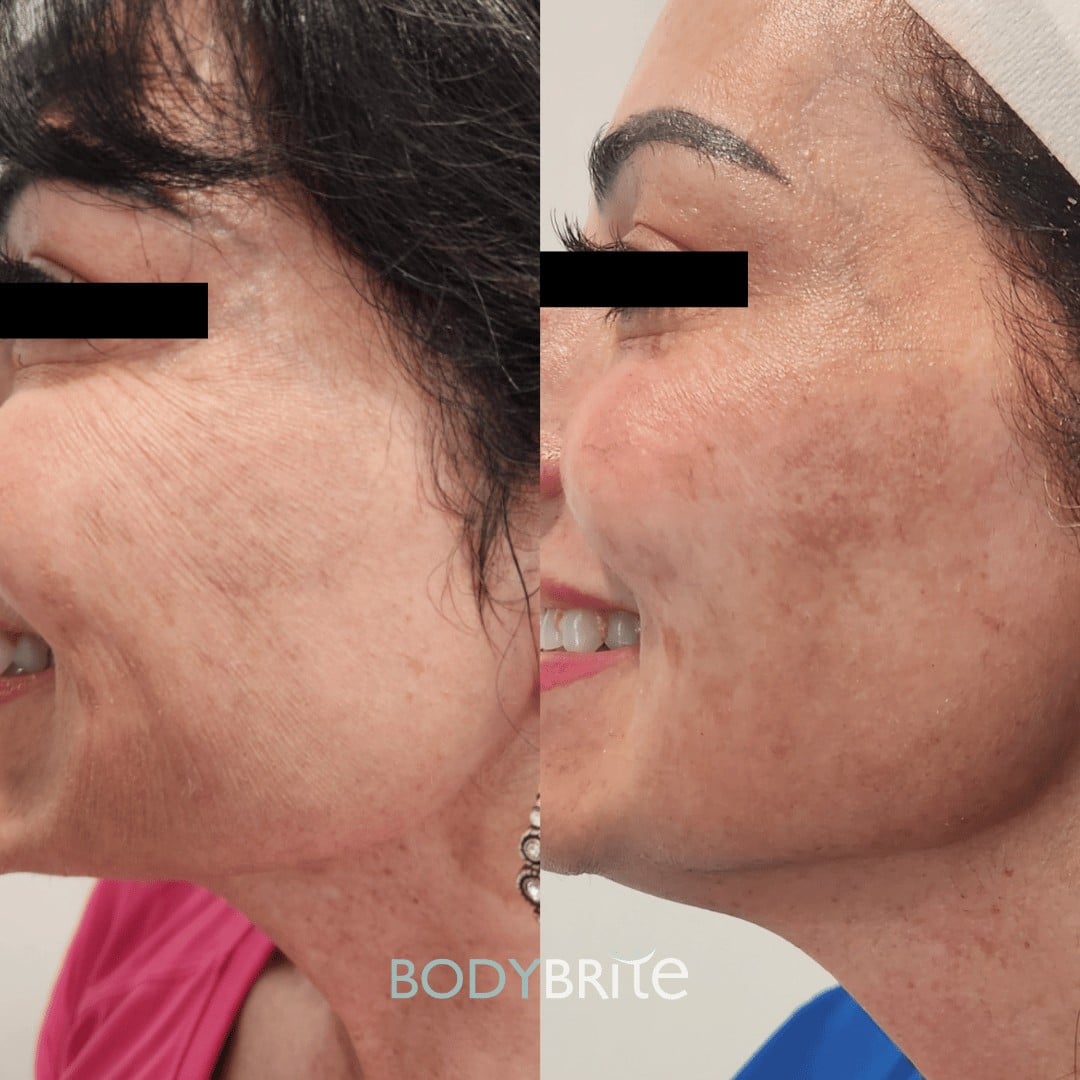 Side-by-side before and after images reveal enhanced skin appearance on a woman's face following a Radiofrequency Microneedling treatment at a med spa in Cooper City. The photos, partially obscured by black bars over the eyes for privacy, illustrate significant wrinkle reduction and smoother skin texture post-procedure.