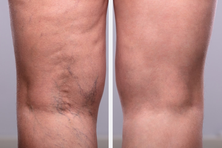 Before and after comparison of a person's leg, showcasing an impressive reduction in varicose veins and significantly improved skin appearance, achieved through state-of-the-art treatments available at med spas in Cooper City.