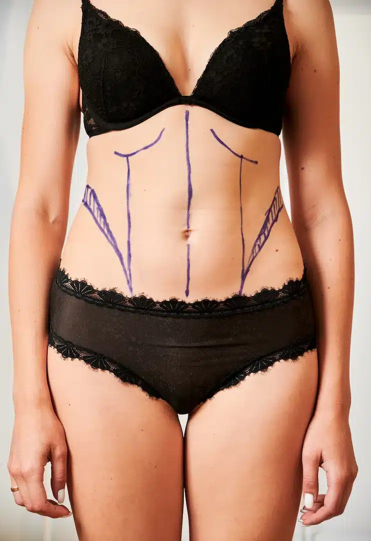 In Cooper City, a person in black underwear proudly displays surgical markings on their abdomen, showcasing the transformative potential of LipoDissolve fat reduction available at Ivy Wellness and Aesthetics med spa.